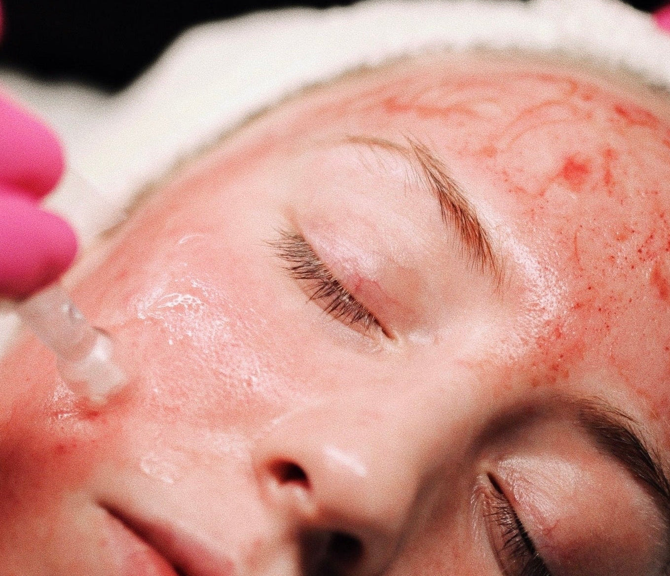 person getting microneedling with plated exosomes at clover skin bar