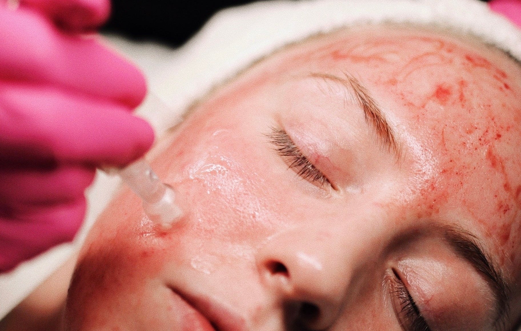 Person getting Microneedling with plated exosomes at Clover Skin Bar